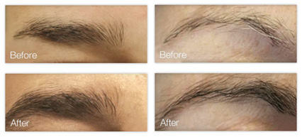 NeuBrow Before & After
