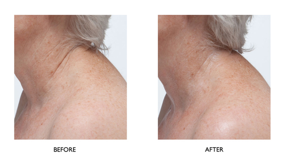 Peter Thomas Roth FirmX Neck & Decollete Creme Before After